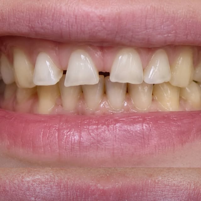 Caso real de diseño de sonrisa